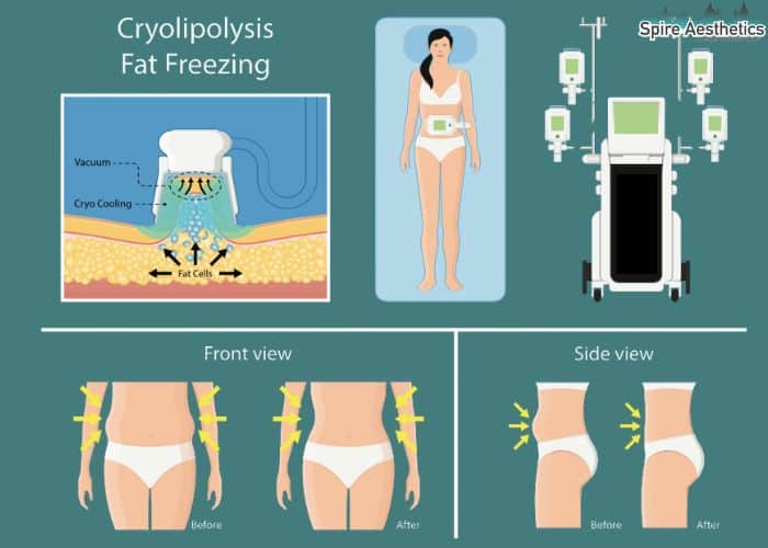 Image of diet and fat freezing combined for best results for Spire Aesthetics Belper