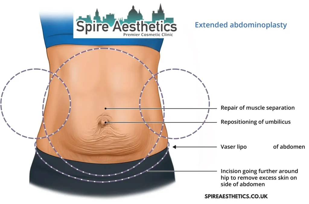 Understanding Loose Skin After Gastric Band Belper Surgery and HIFU Treatment