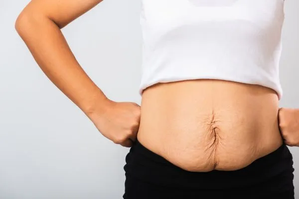 Image of a woman's stomach after weight loss with sagging skin following a gastric band Belper