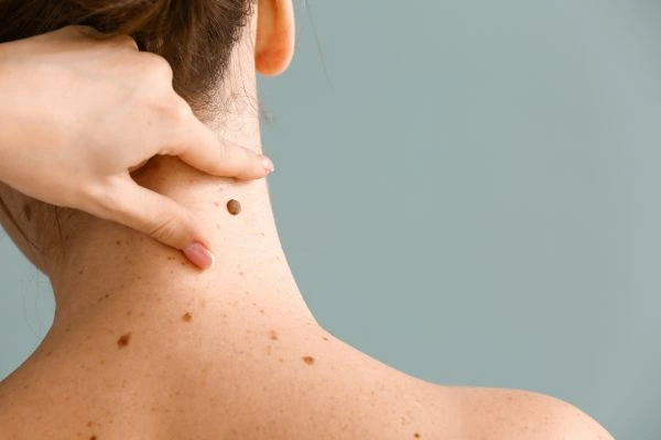skin blemish removal Belper treatment