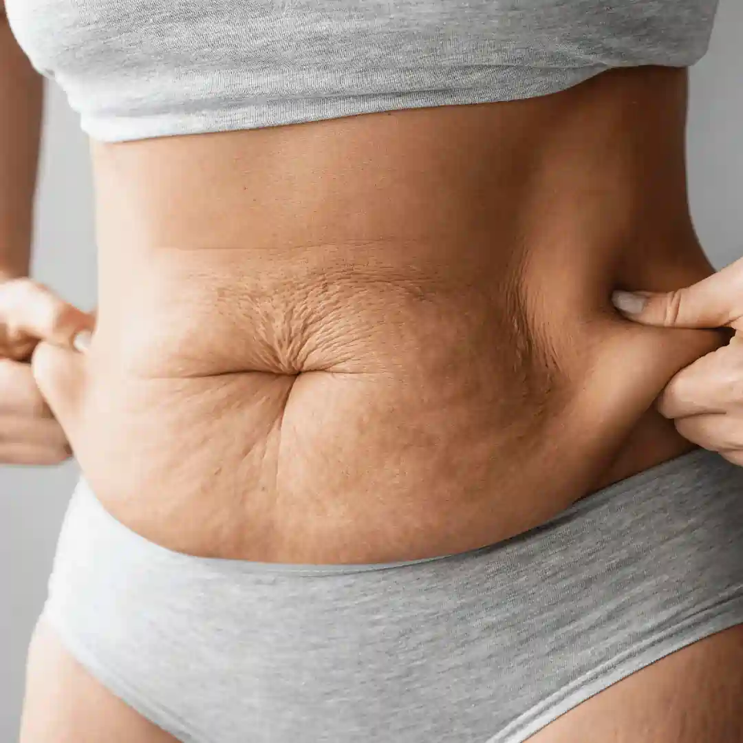 Is It Normal to Have Loose Skin After Pregnancy Belper?